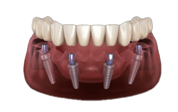 implant render