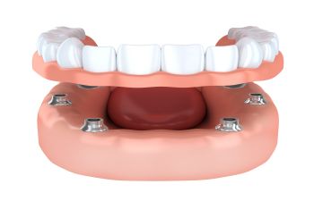 The Advantages of All-on-4 Implant Dentures Napa, CA