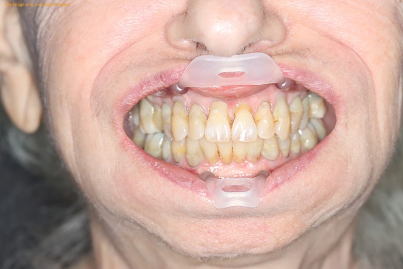 female patient before all on 4 dental implants procedure